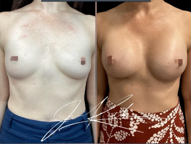 Breast Augmentation — clinical photograph 1 from Envision Plastic Surgery