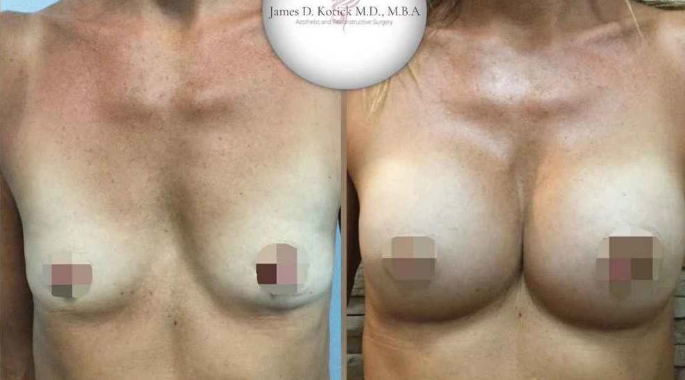 Breast Augmentation — clinical photograph 6 from Envision Plastic Surgery