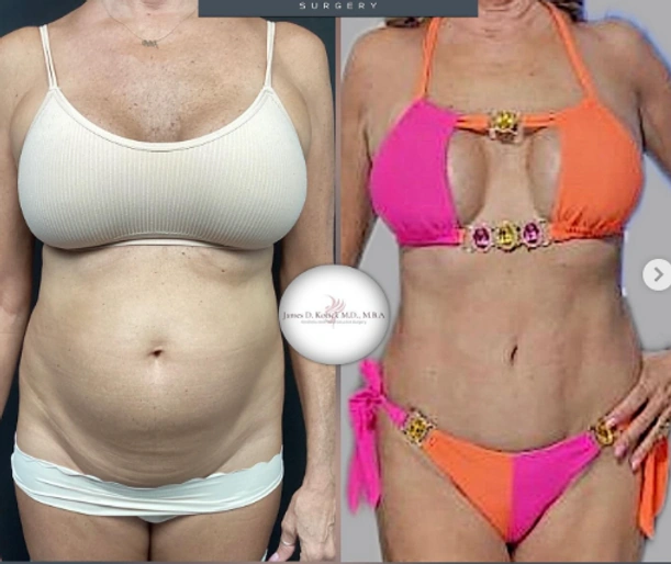 Liposuction — clinical photograph 2 from Envision Plastic Surgery